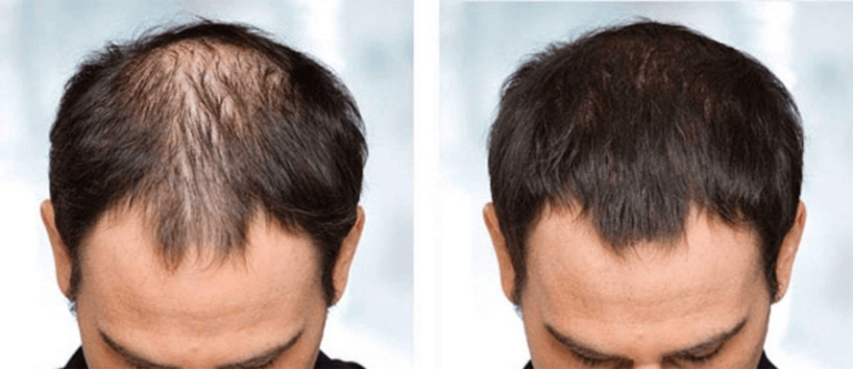 New Advancements in Hair Loss Treatment: What do you need to Know?